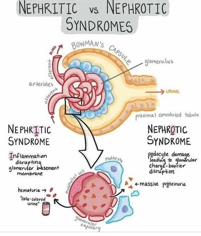 Nephritic  Vs Nephrotic Syndrome
