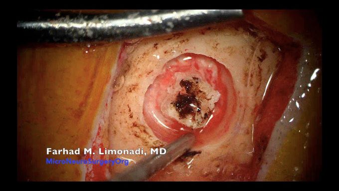 Surgical resection of Skull Giant Cell Granuloma