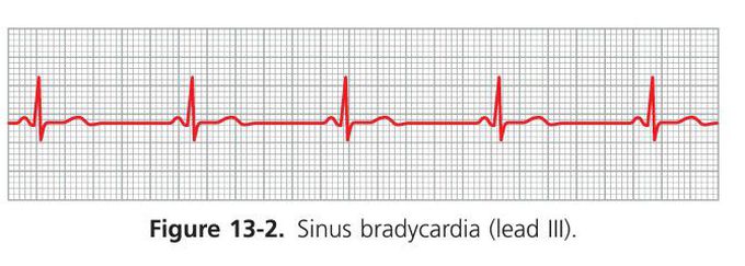 Sinus bradycardia