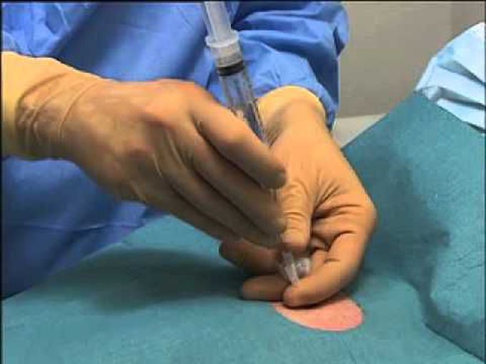 Pneumothorax Needle Aspiration
