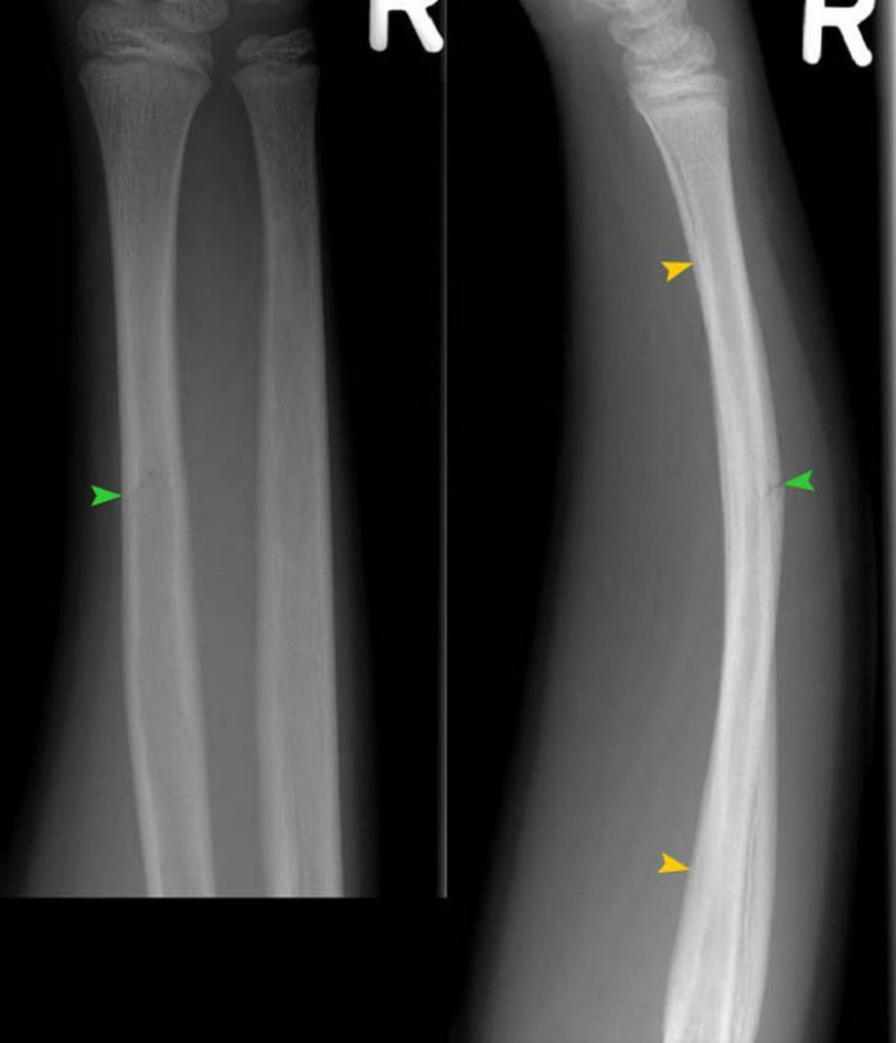 Pseudofracture - MEDizzy