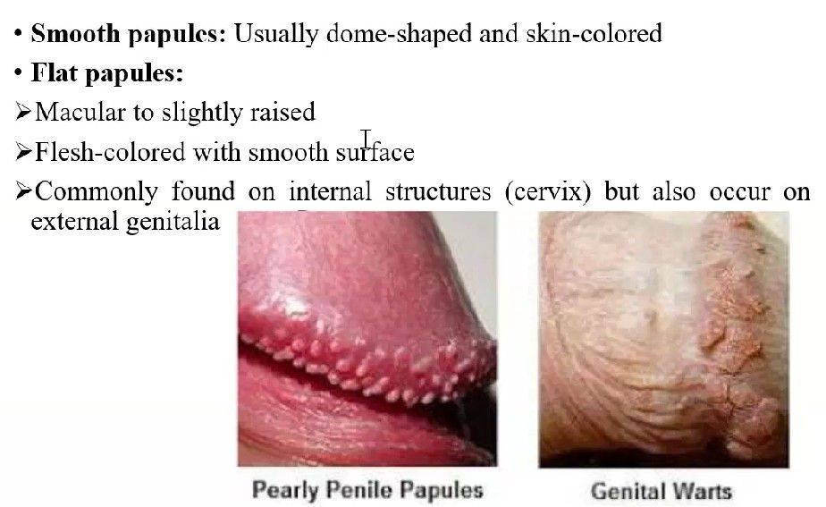 pearly penile papules vs genital warts