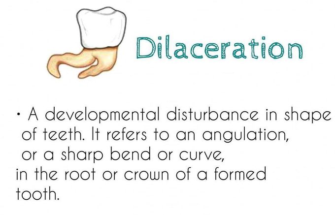 Dilaceration