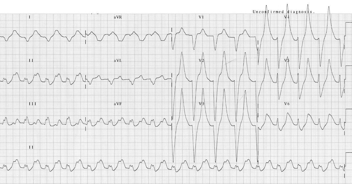 Peaked T Waves On Ecg In A Patient With Hyperkalemia Medizzy 8022