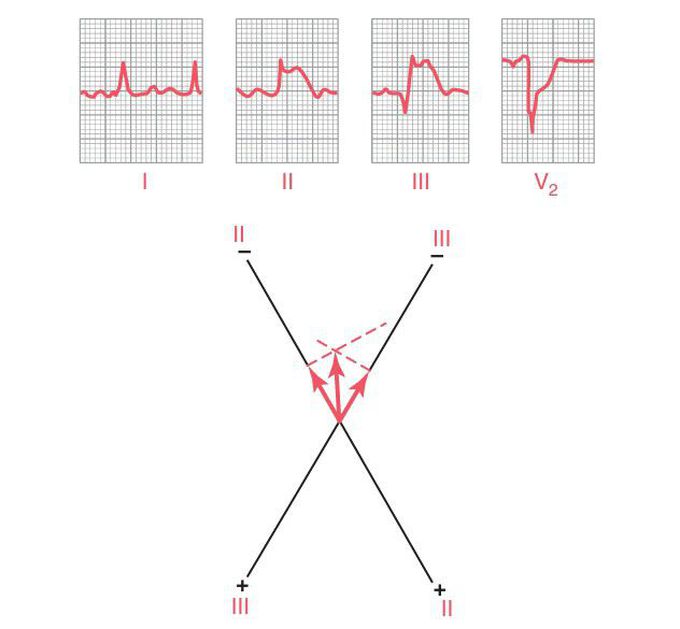 Posterior wall infarction