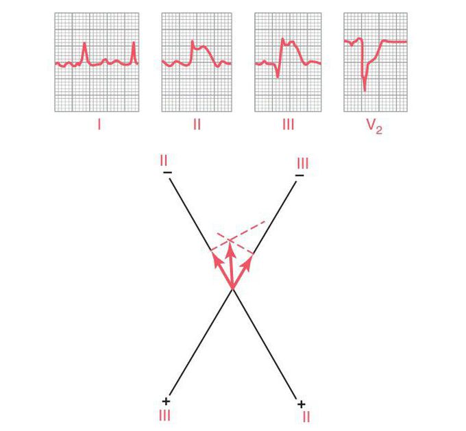 Posterior wall infarction