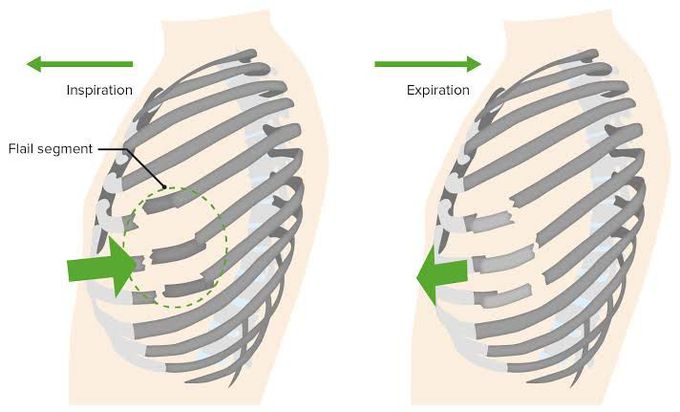 Flail chest