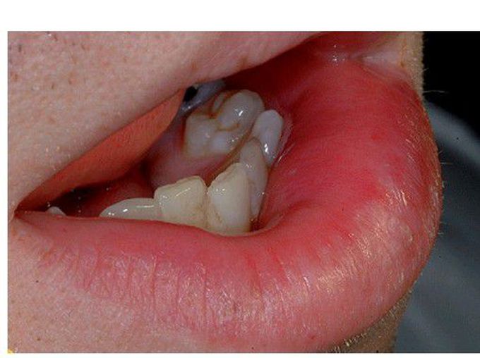 Granulomatous cheilitis
