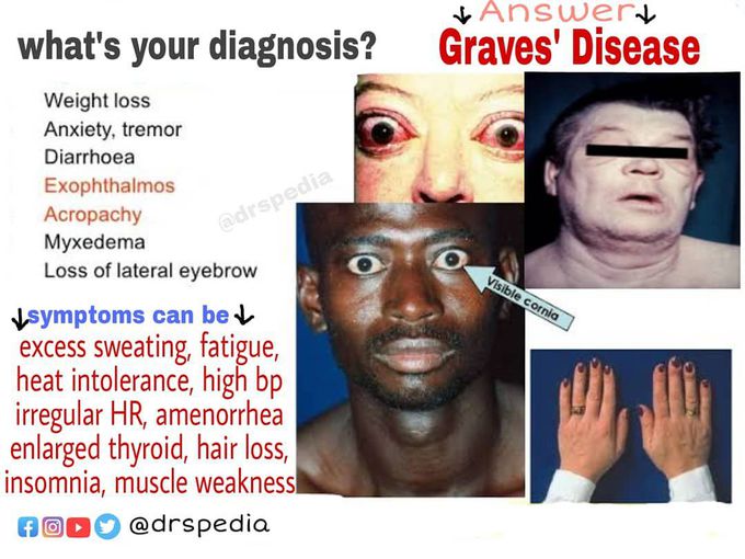 Graves’ Disease