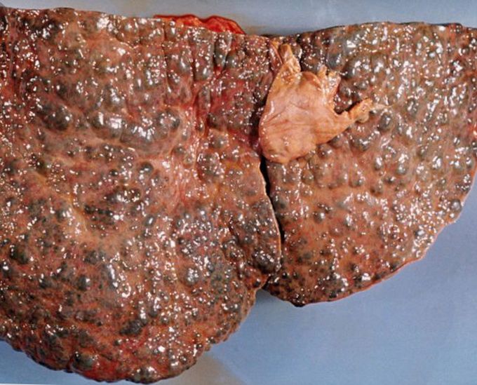Liver cirrhosis
