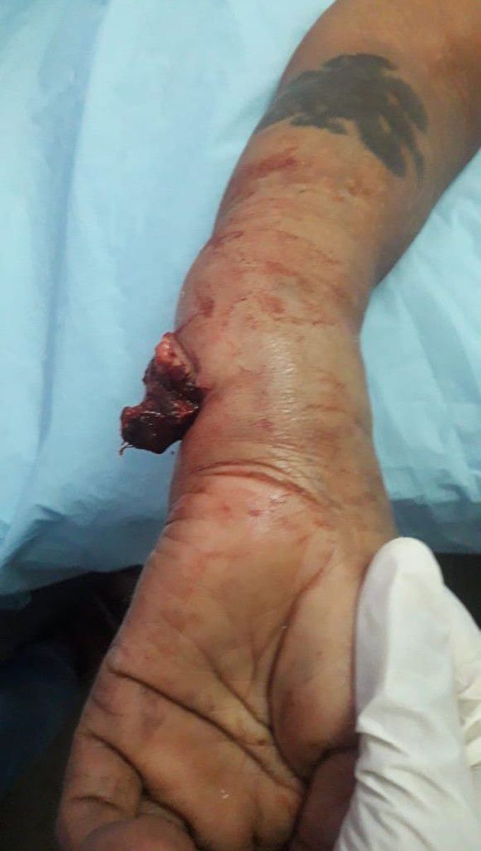 Fracture of hand ( Radius and ulna )