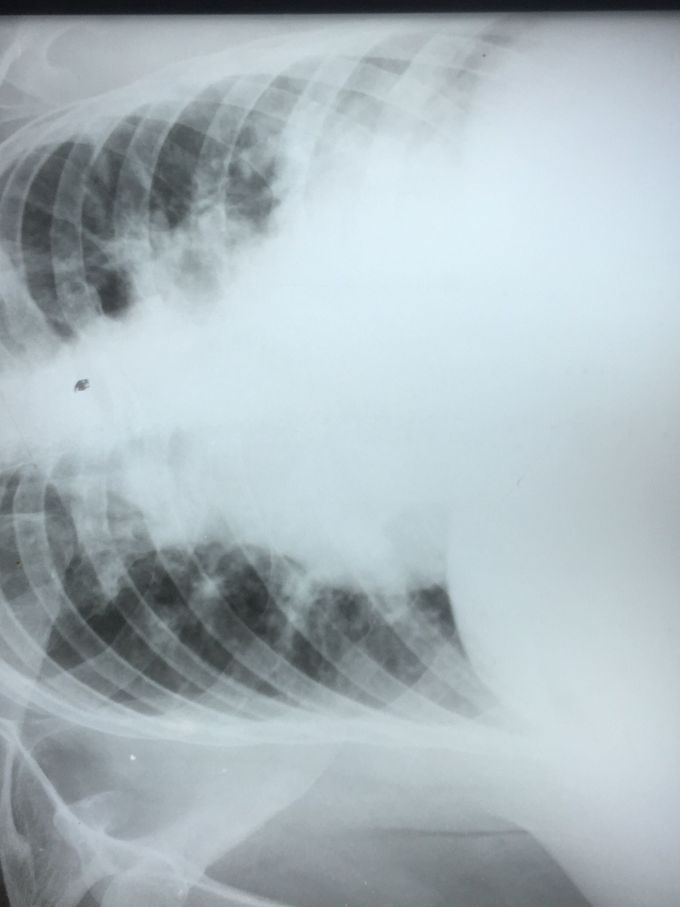 Thorax X-Ray - MEDizzy