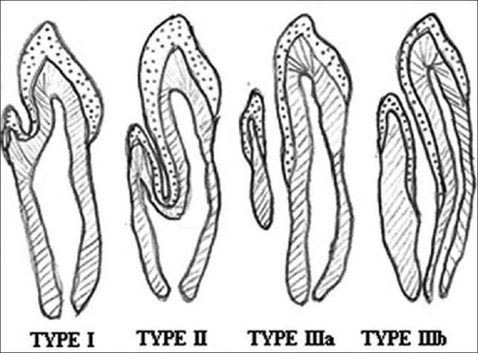 Dens Invaginatus- Classification