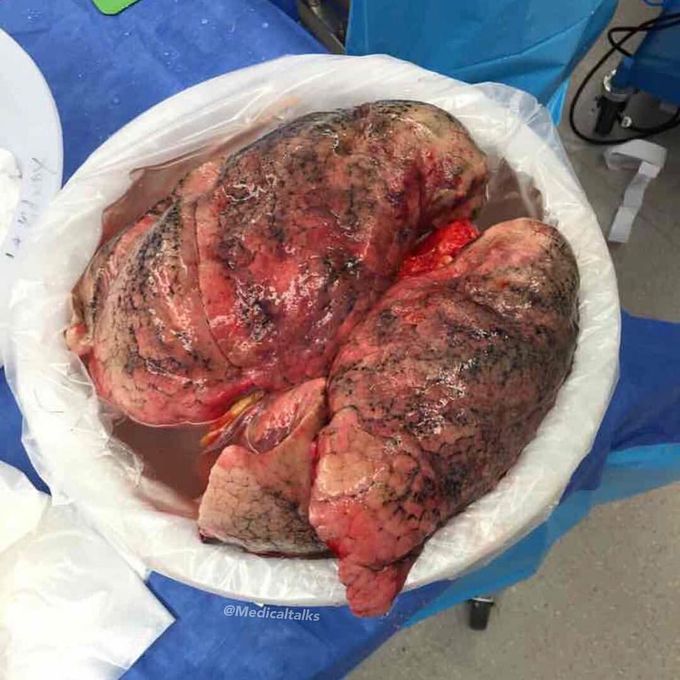 Smokers’ lungs for transplant!! 
