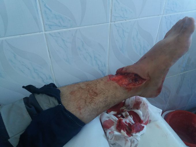 Hurt trauma bleeding