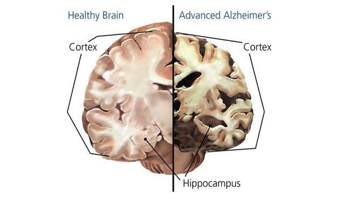 Alzheimer