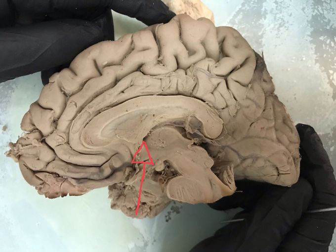 Sagittal section of the brain: name the structure