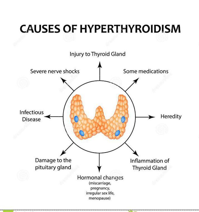Causes of hyperthyroidism