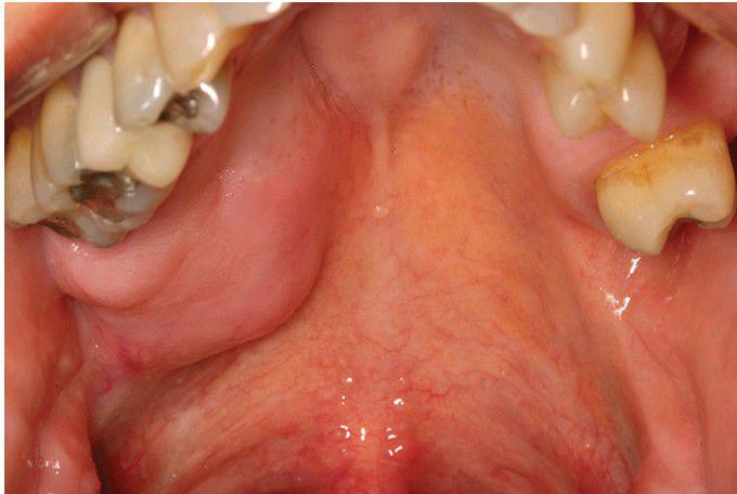 Polymorphous Low-Grade Adenocarcinoma