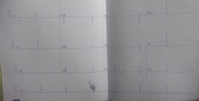Electro cardio graph