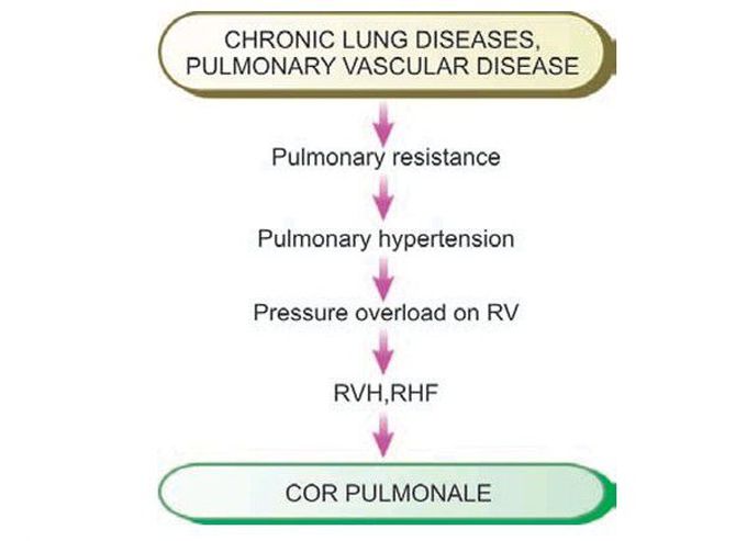 Cor pulmonale