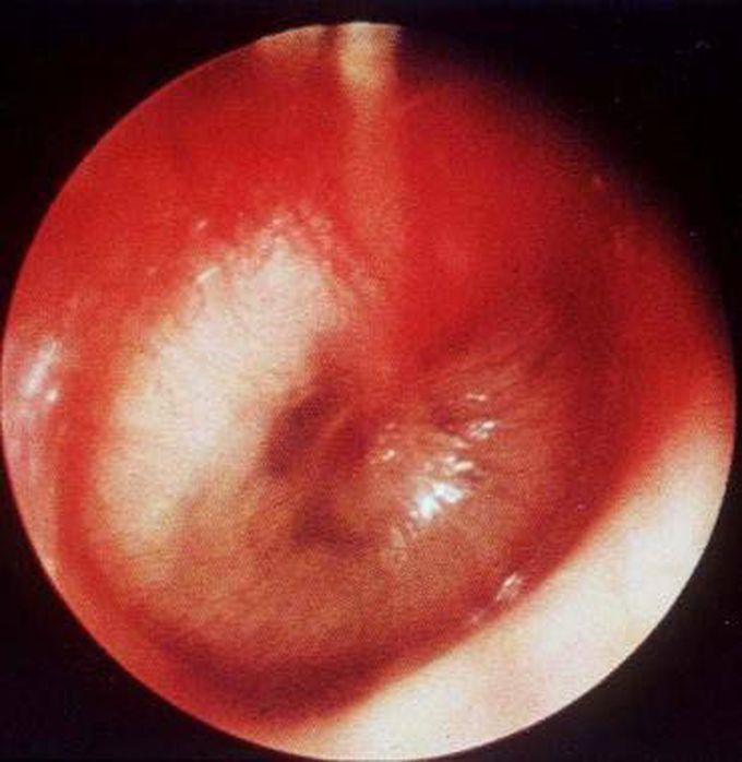 What is otitis media?