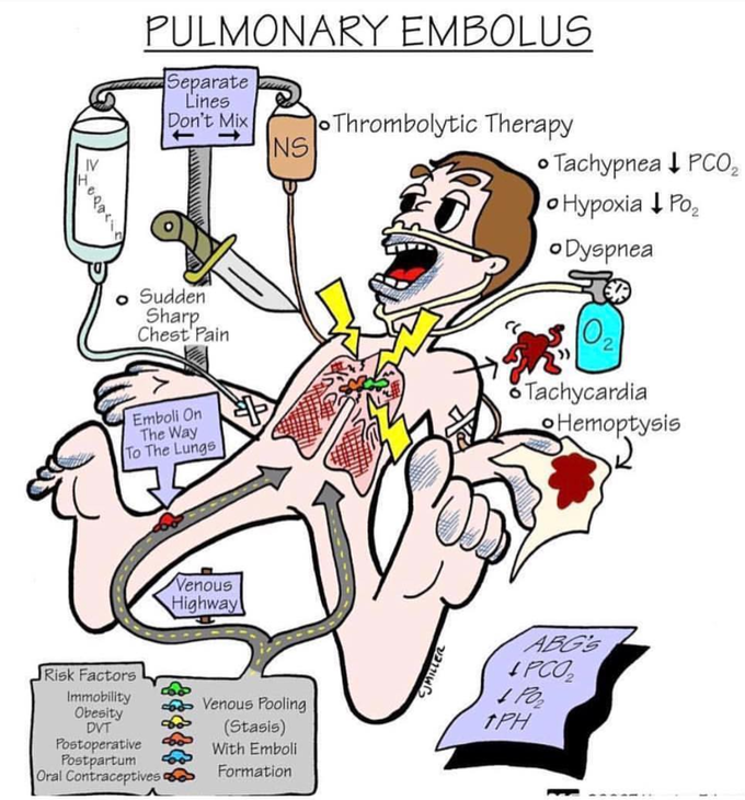 Pulmonary embolism