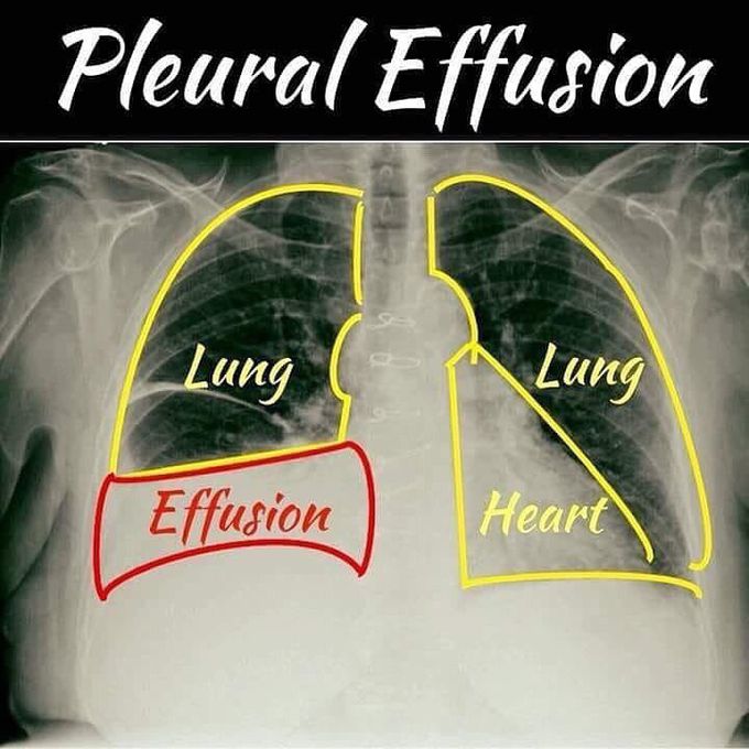 This is the Pleural Effusion!