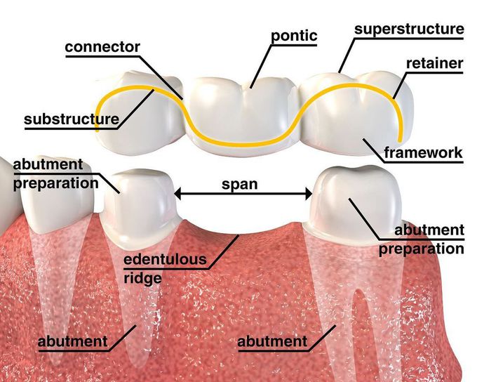 Dental bridges