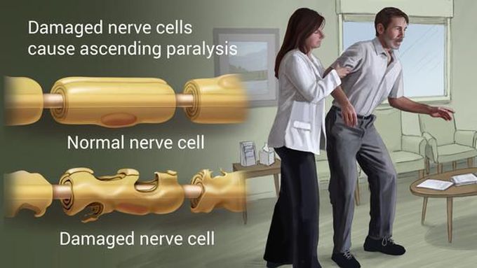 Key Facts about Guillain-Barré syndrome (GBS)