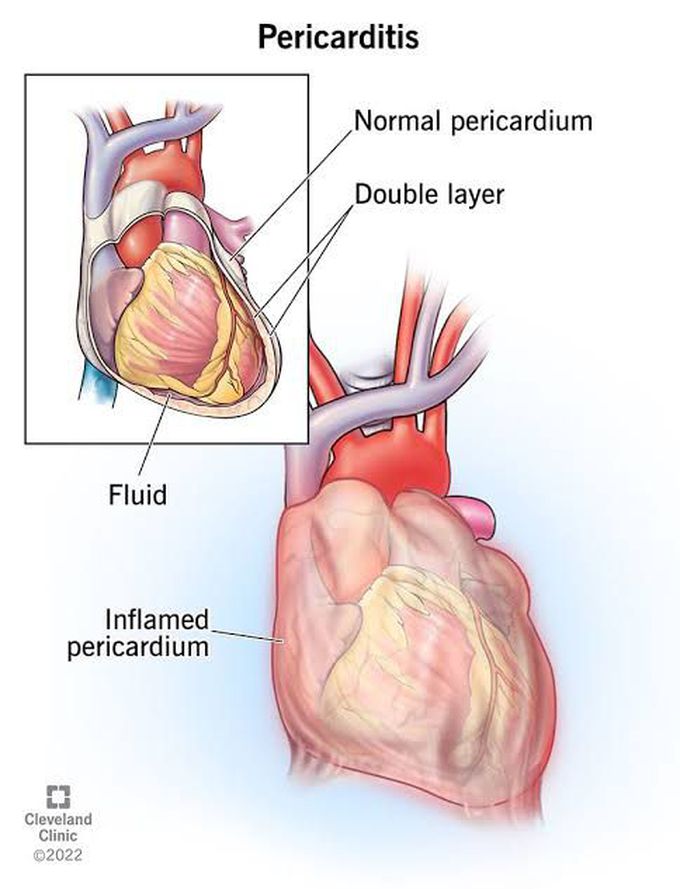 Treatment of pericarditis