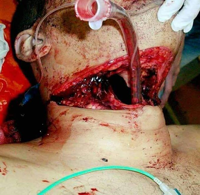 Tracheal intubation