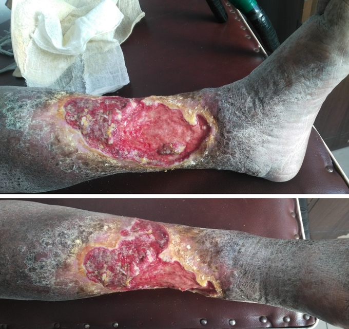 Venous Ulcers