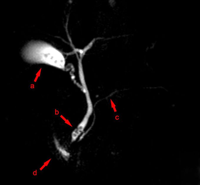 Magnetic Resonance Cholangiopancreatography (MRCP)