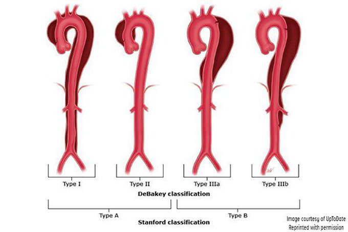 Aortic Dissection