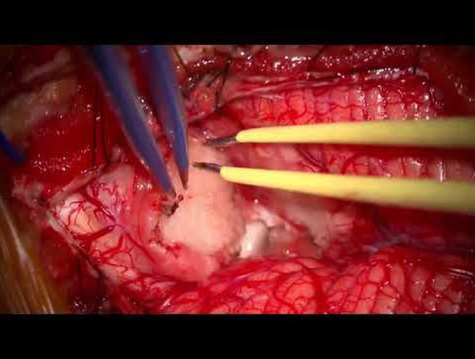Midline suboccipital craniotomy and direct stimulation for a dorsally exophytic brainstem tumor