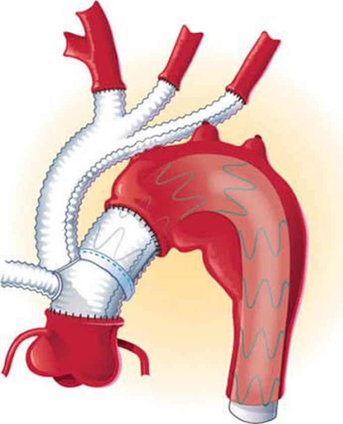 Hybrid Aortic Arch Debranching