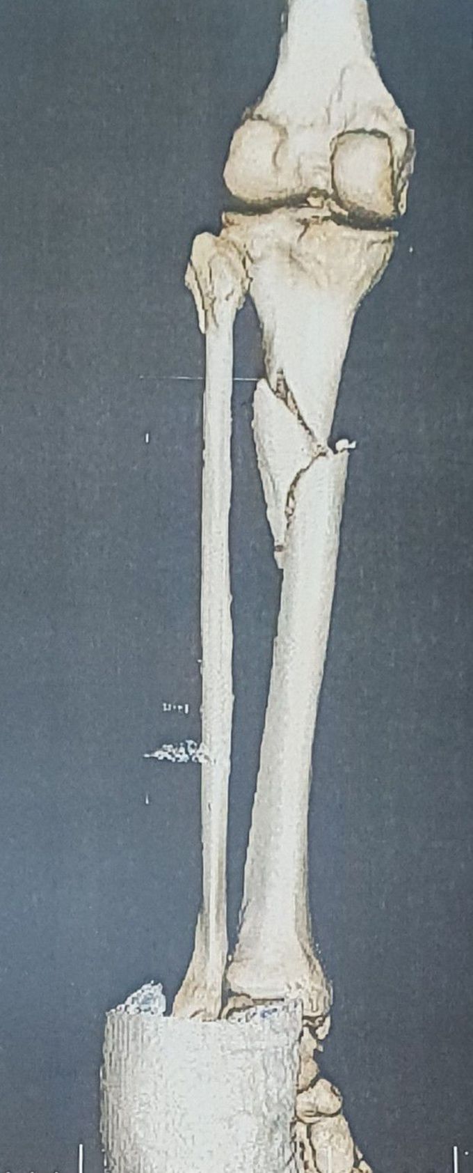 Tibia wedge shape fracture