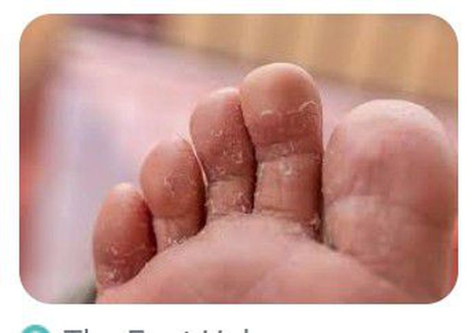 Cause of Athlete's foot - MEDizzy