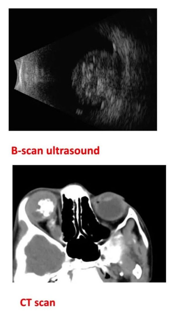 Retinoblastoma V