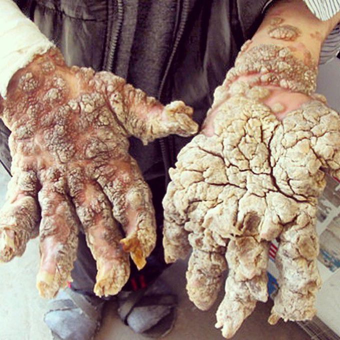 Epidermodysplasia Verruciformis