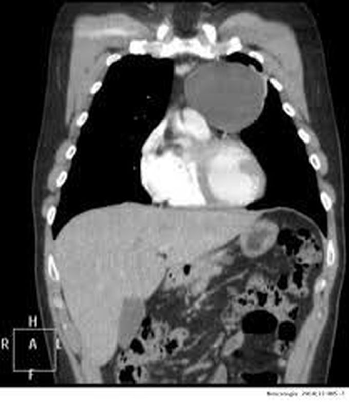 Thymic cyst