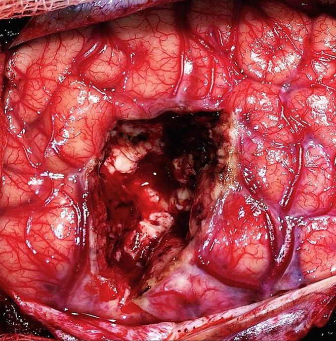 Photo following a surgical drainage of a brain abscess.  