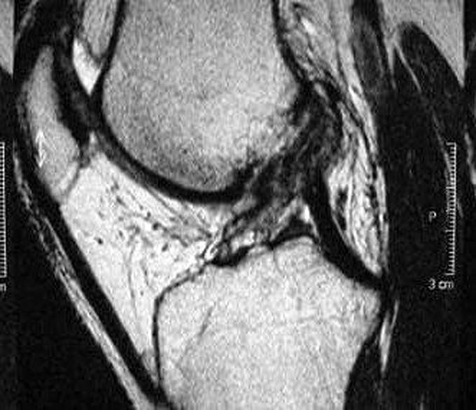 Which ligament is tear in this image of a patient?