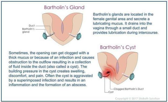 Bartholin's gland and bartholin's cyst