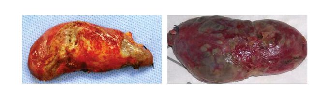  In Which organ this inflammation occurs !?   😄