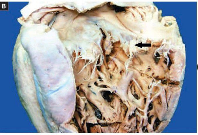 Infective endocarditis