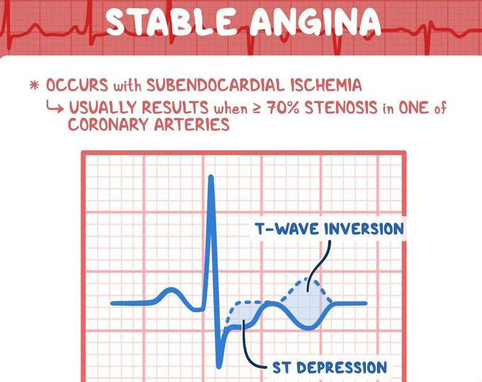 Stable Angina