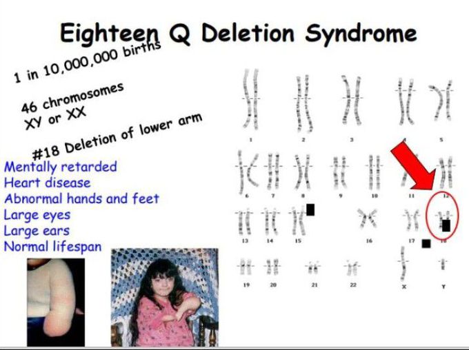Eighteen Q deletion syndrome