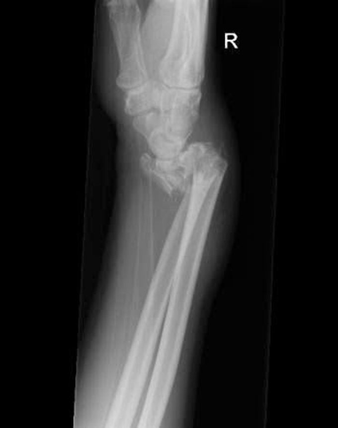 Smith fracture